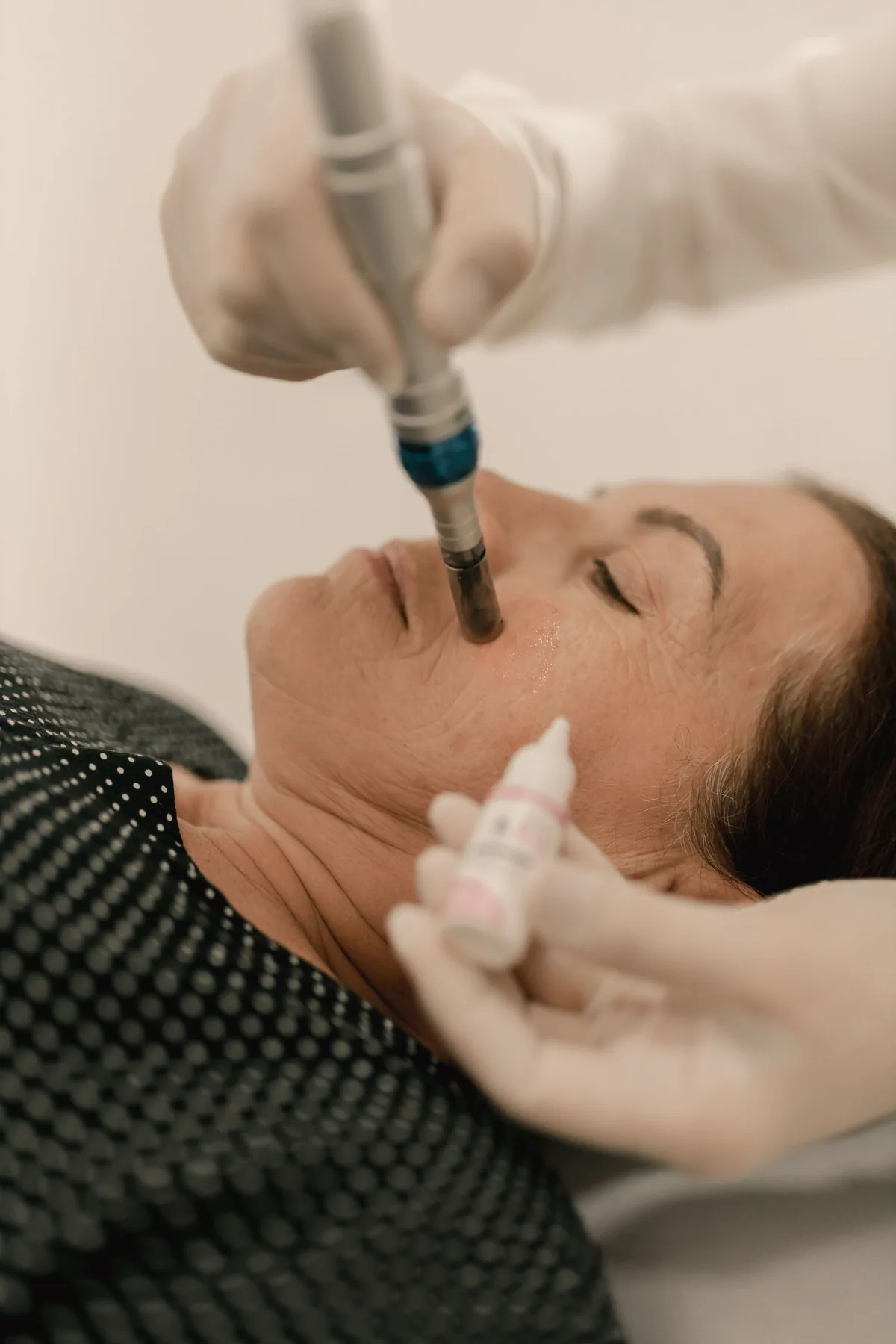 Microneedling-behandling i ansiktet